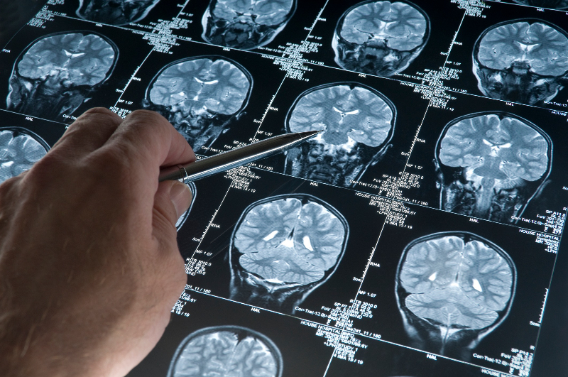 Tackling Alzheimer's (Option 2)